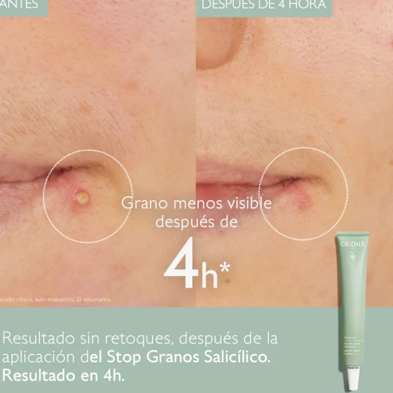 VINOPURE STOP GRANOS SALICÍLICO